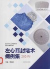 左心耳封堵术病例集  2024