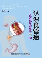 认识食管癌  食管癌早诊早治30问